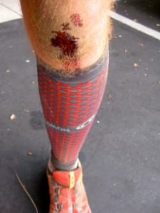 Just a flesh wound... specifically, a capillary bleed.