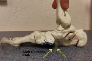Medial view of a collapsed arch.