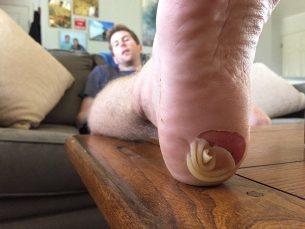 A blister from heelstriking while running donwhill