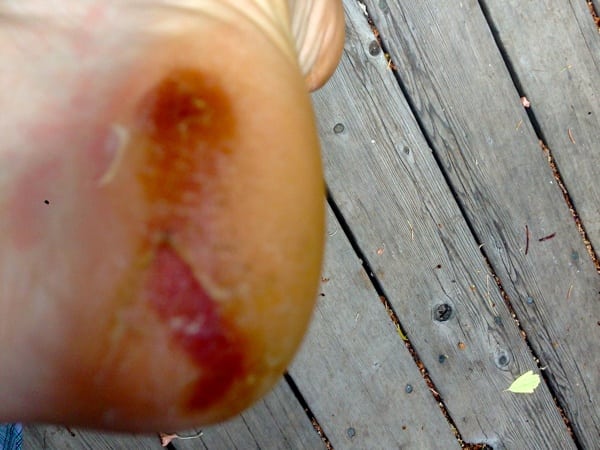 Bryon Powell - 2013 Western States 100 - heel blister