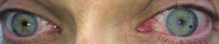 Corneal Edema in an Ultra-Distance Mountain Biker 1