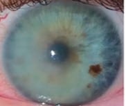 Corneal Edema in an Ultra-Distance Mountain Biker 2