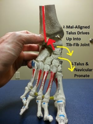 The mechanism for high ankle sprains in trail runners: a pronated foot creates a mal-aligned talus, which gets driven upward into the tibial-fibular joint.