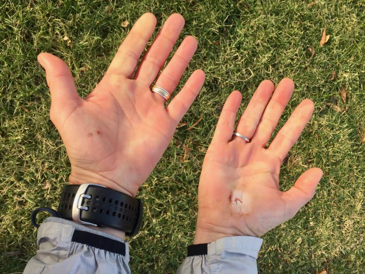 Trail First Aid Frostbite Irunfar