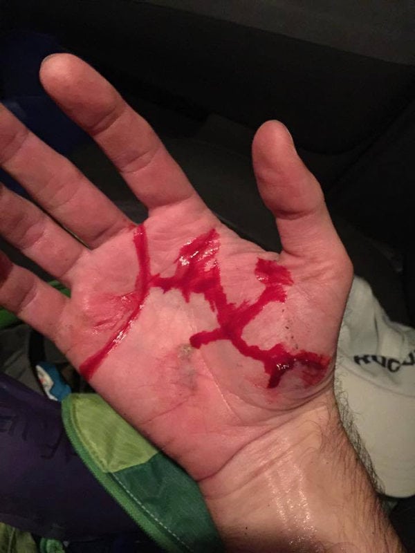 Hand Injury