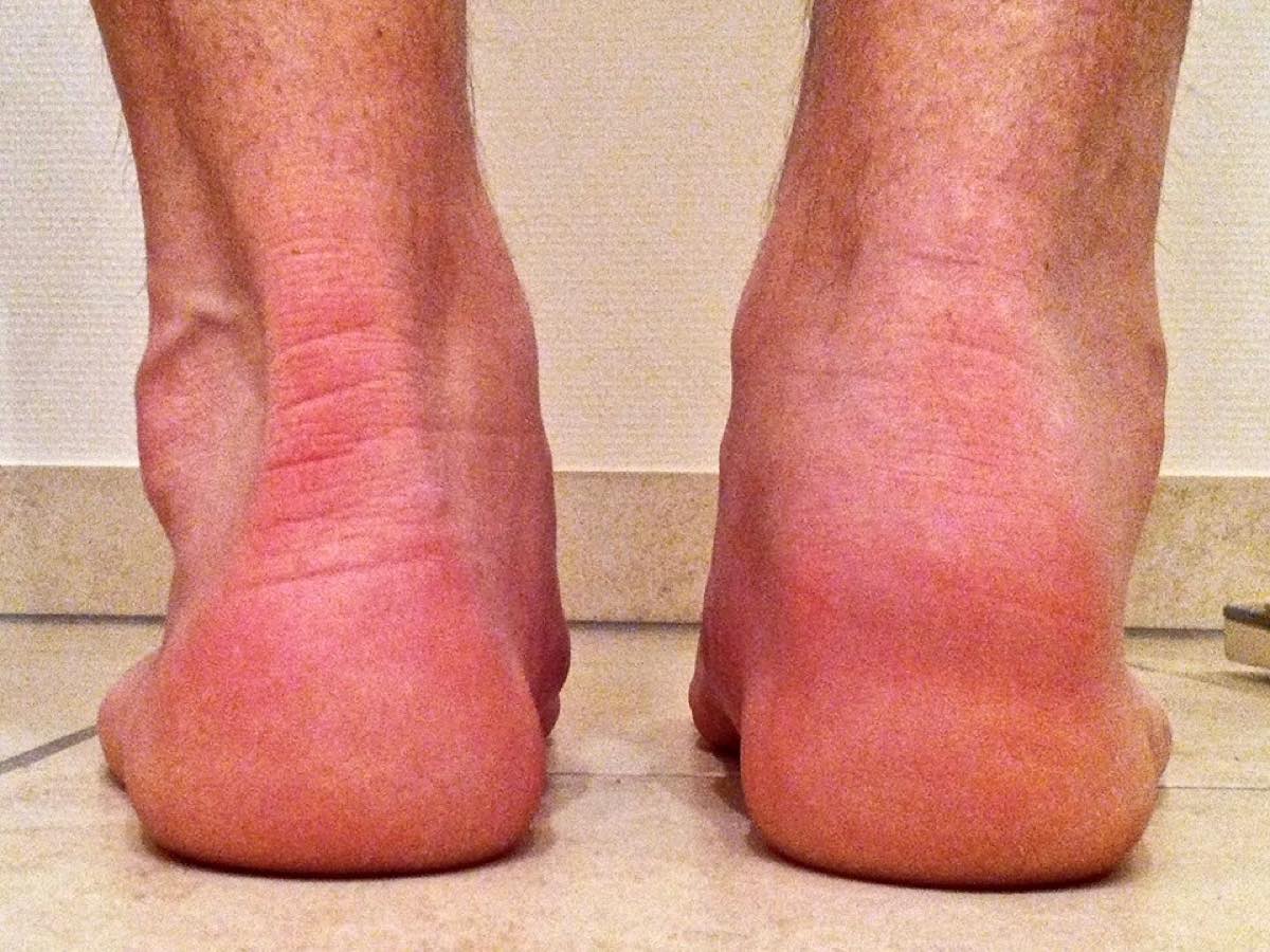 intermittent heel pain