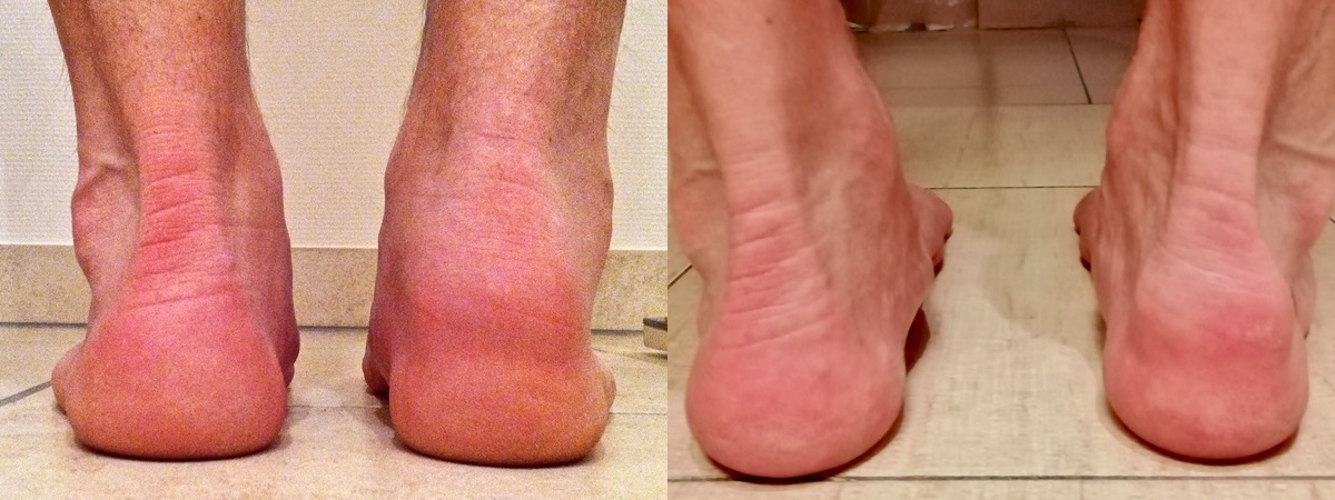 best athletic shoes for haglund's deformity