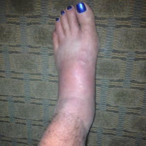 Joe Fejes - swollen foot