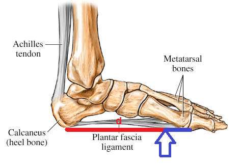 plantar fasciitis forefoot pain