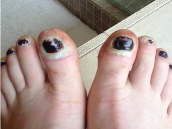 Toe still numb after ingrown toenail surgery