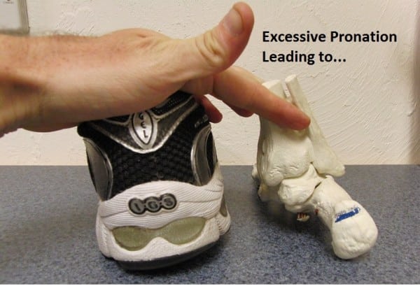 pronation of foot shoes